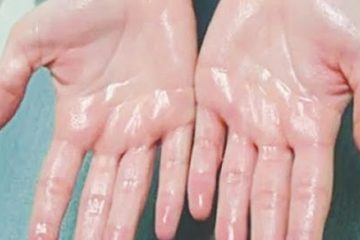 CÁC LOẠI THUỐC CHỮA BỆNH MỒ HÔI TAY,MỒ HÔI CHÂN