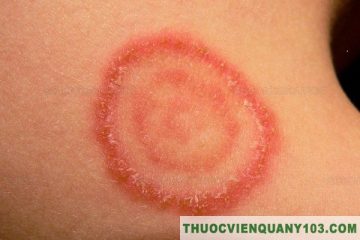 thuốc trị nấm Trung Quốc